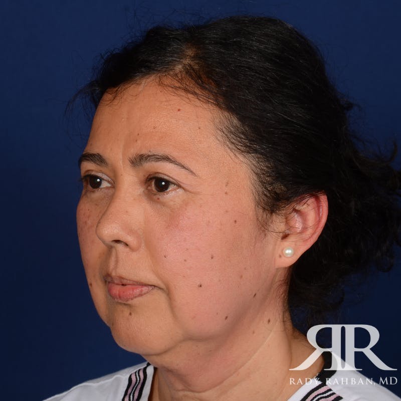 Facelift Before & After Gallery - Patient 419967 - Image 3
