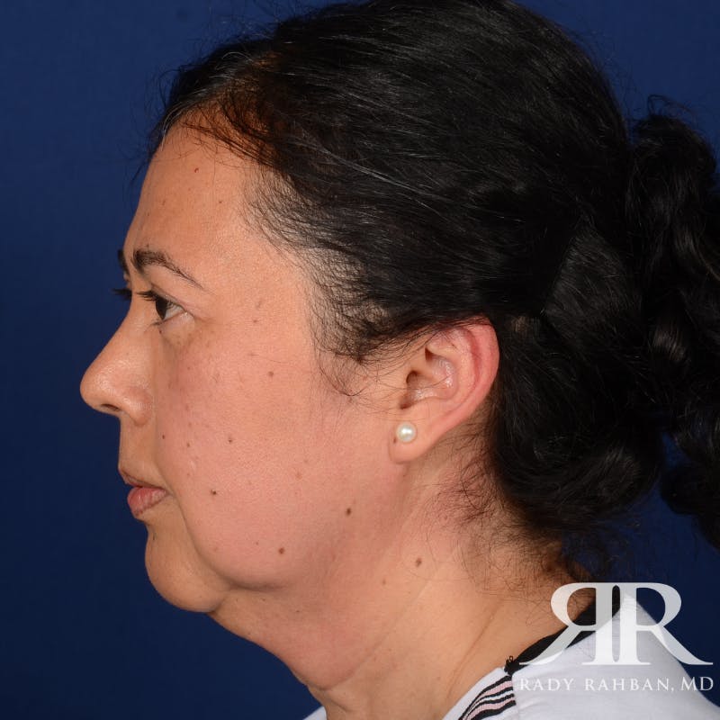 Facelift Before & After Gallery - Patient 419967 - Image 5