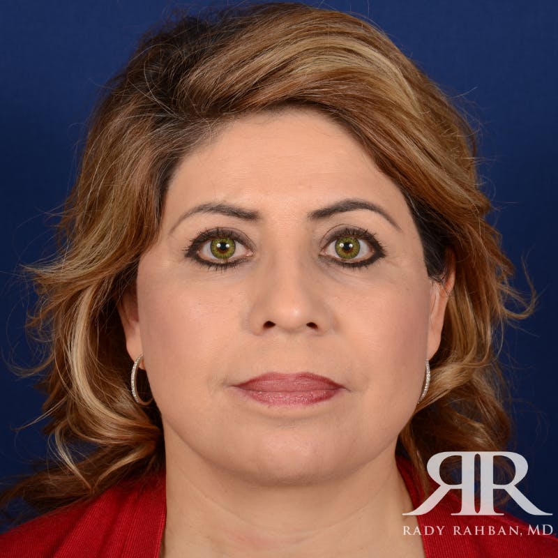 Facelift Before & After Gallery - Patient 272052 - Image 2