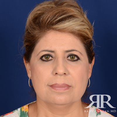 Facelift Before & After Gallery - Patient 272052 - Image 1