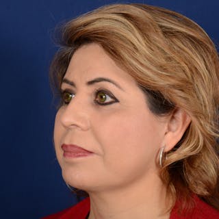 Facelift Before & After Gallery - Patient 272052 - Image 4