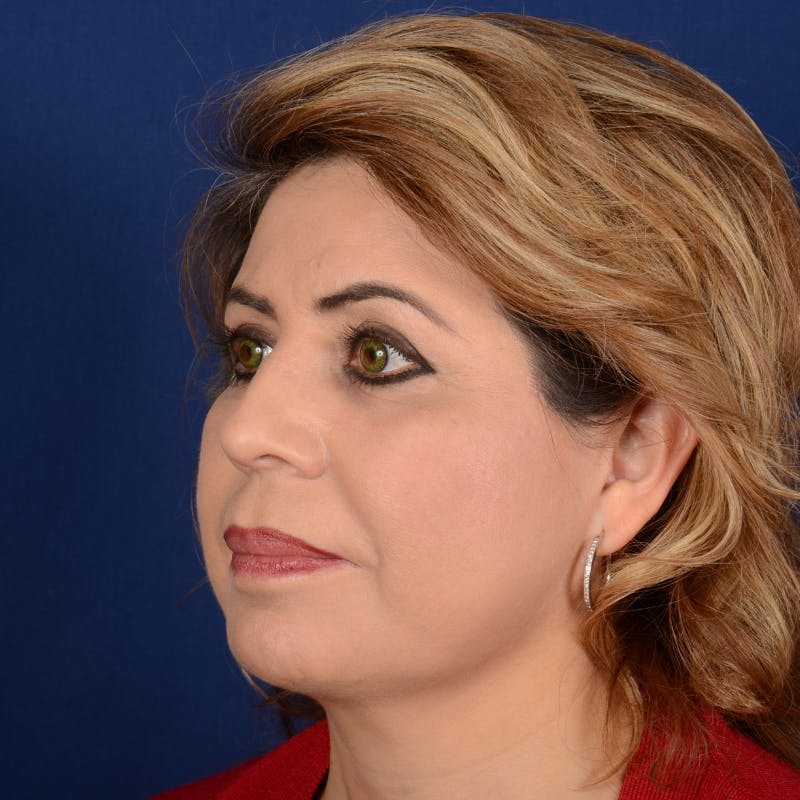 Facelift Before & After Gallery - Patient 272052 - Image 4