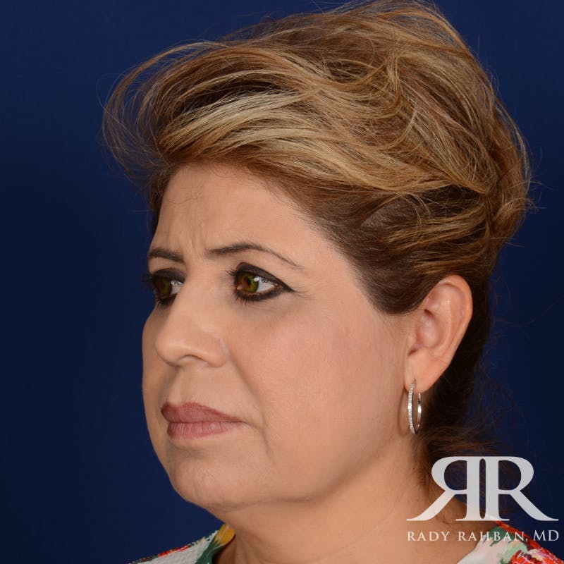 Facelift Before & After Gallery - Patient 272052 - Image 3