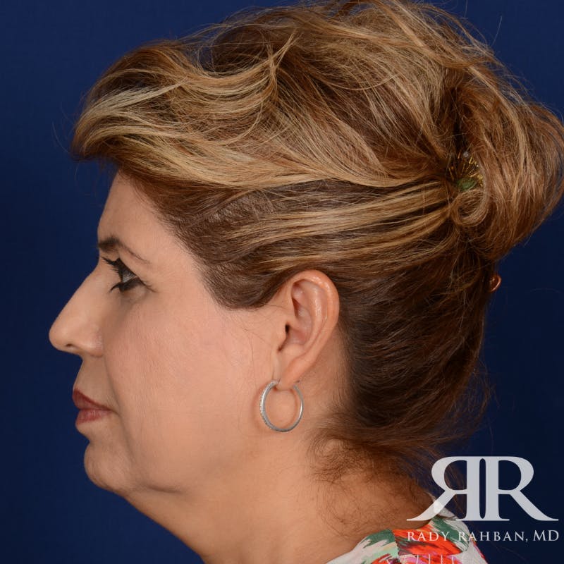 Facelift Before & After Gallery - Patient 272052 - Image 5