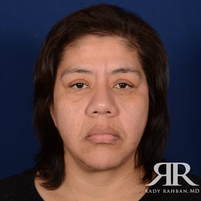 Facelift Before & After Gallery - Patient 404389 - Image 2
