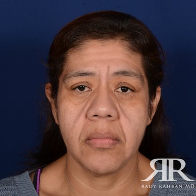 Facelift Before & After Gallery - Patient 404389 - Image 1