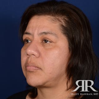 Facelift Before & After Gallery - Patient 404389 - Image 4