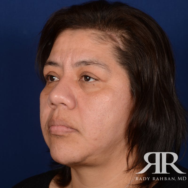 Facelift Before & After Gallery - Patient 404389 - Image 4