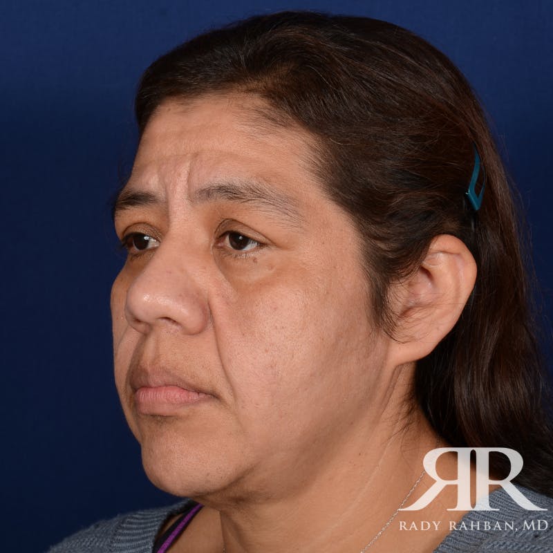 Facelift Before & After Gallery - Patient 404389 - Image 3