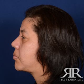 Facelift Before & After Gallery - Patient 404389 - Image 6