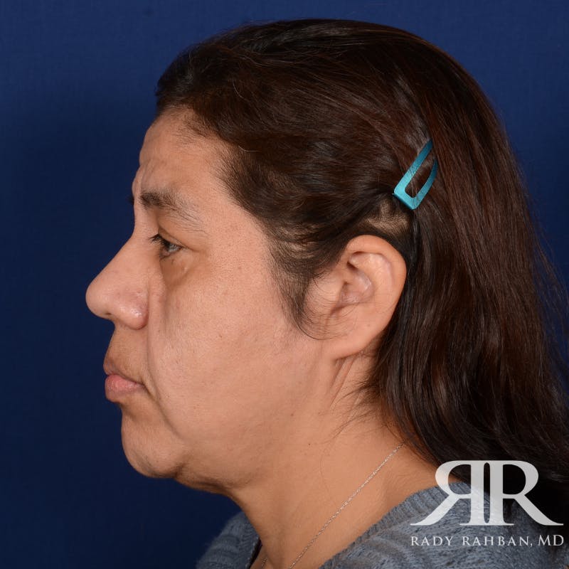 Facelift Before & After Gallery - Patient 404389 - Image 5