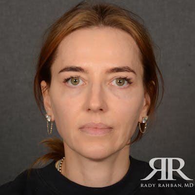 Facelift Before & After Gallery - Patient 219861 - Image 1