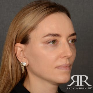 Facelift Before & After Gallery - Patient 219861 - Image 4