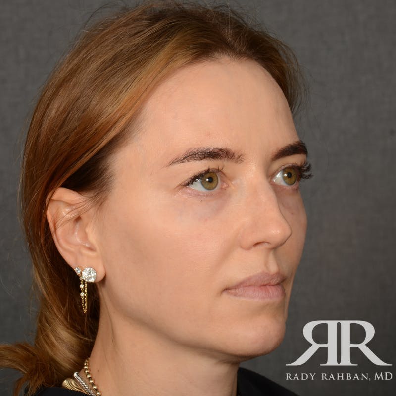 Facelift Before & After Gallery - Patient 219861 - Image 3