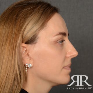 Facelift Before & After Gallery - Patient 219861 - Image 6