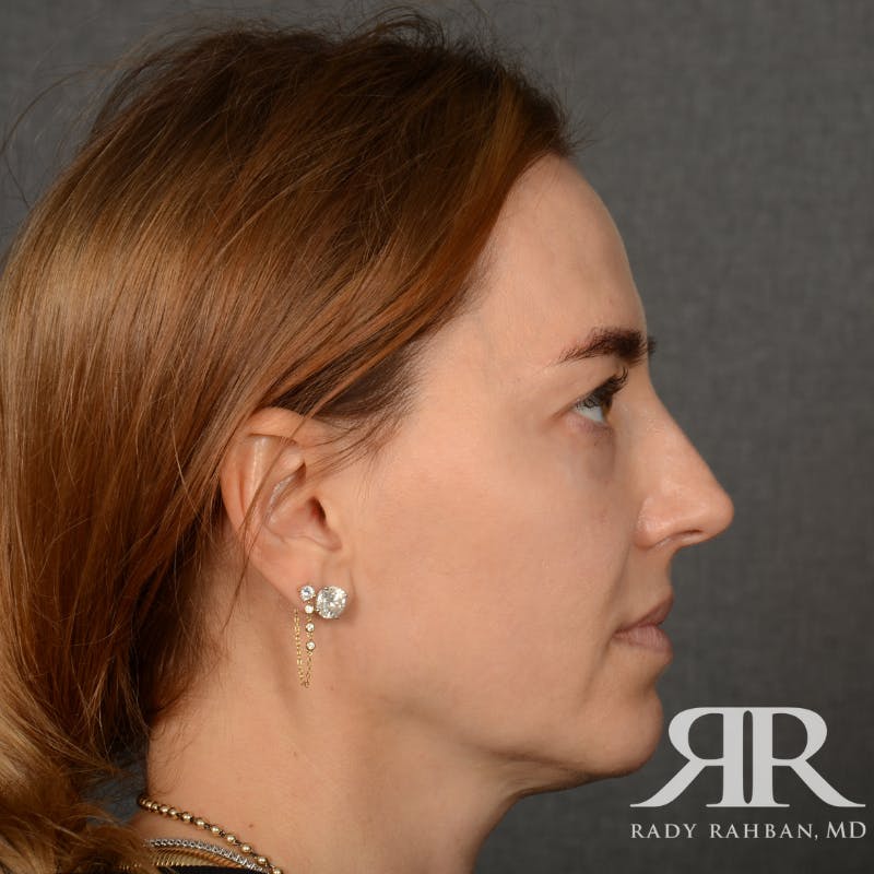 Facelift Before & After Gallery - Patient 219861 - Image 5