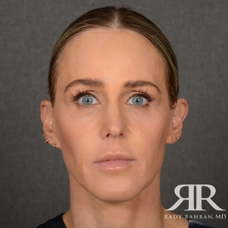 Facelift Before & After Gallery - Patient 709932 - Image 2