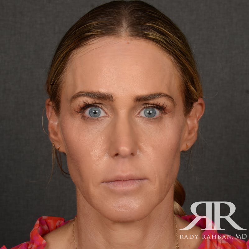 Facelift Before & After Gallery - Patient 709932 - Image 1