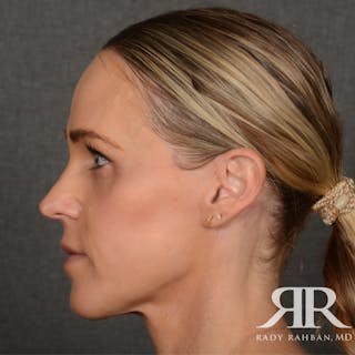 Facelift Before & After Gallery - Patient 709932 - Image 6