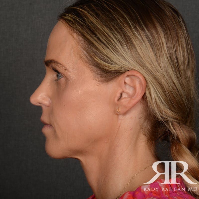 Facelift Before & After Gallery - Patient 709932 - Image 5