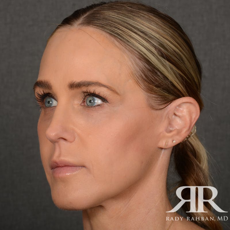 Facelift Before & After Gallery - Patient 709932 - Image 4