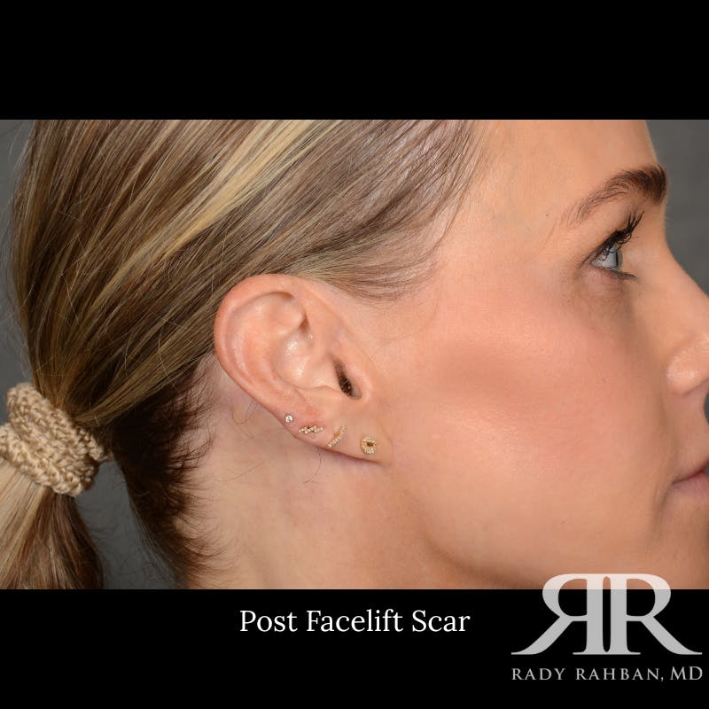 Facelift Before & After Gallery - Patient 709932 - Image 8
