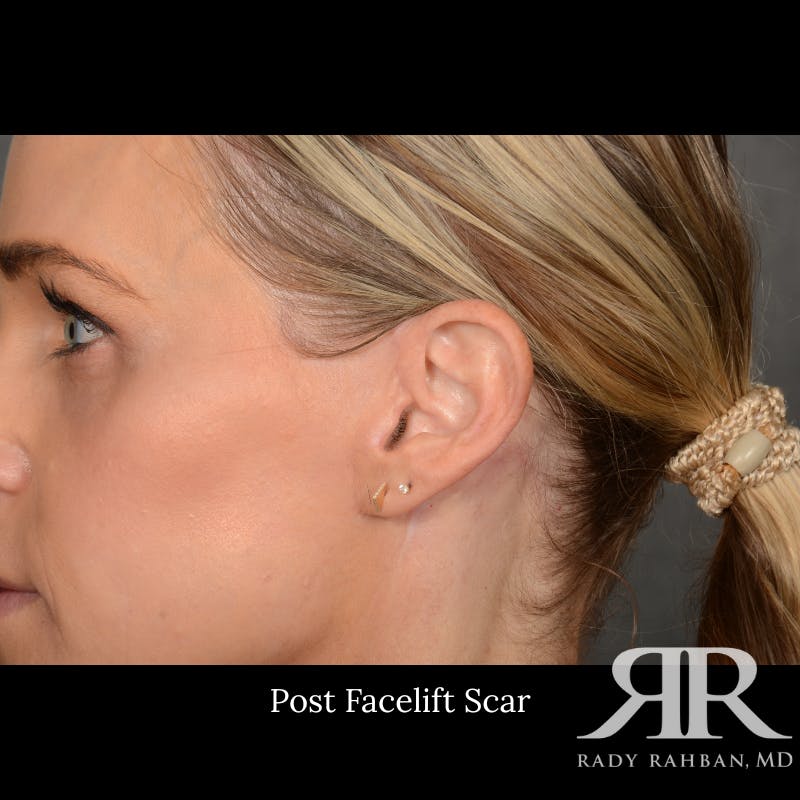 Facelift Before & After Gallery - Patient 709932 - Image 7