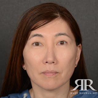 Facelift Before & After Gallery - Patient 201733 - Image 2