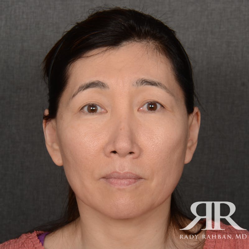 Facelift Before & After Gallery - Patient 201733 - Image 1