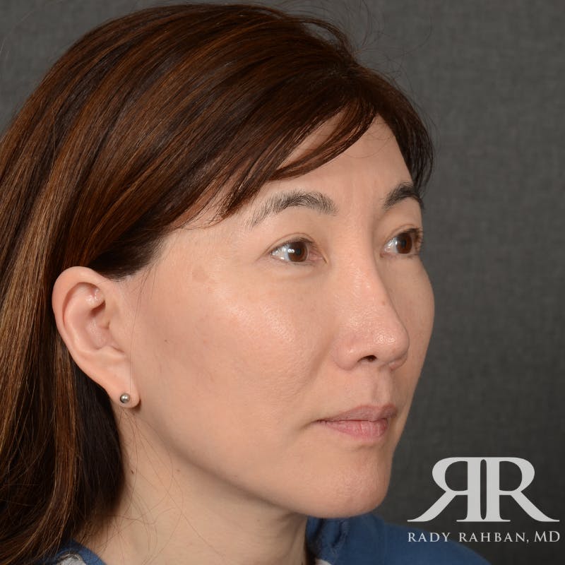 Facelift Before & After Gallery - Patient 201733 - Image 4