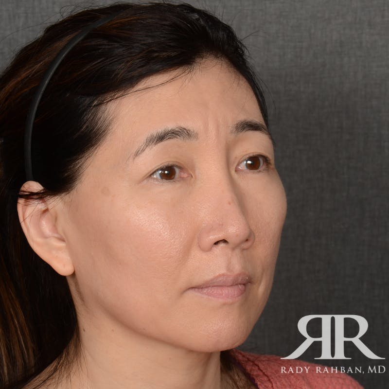Facelift Before & After Gallery - Patient 201733 - Image 3