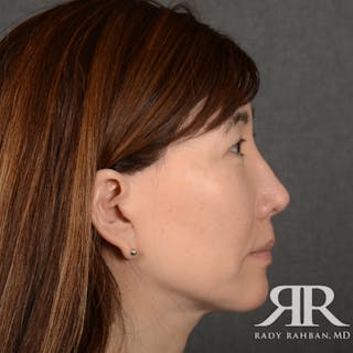 Facelift Before & After Gallery - Patient 201733 - Image 6
