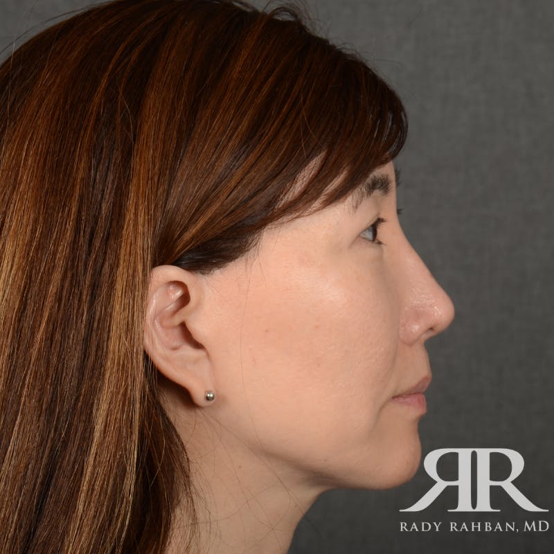Facelift Before & After Gallery - Patient 201733 - Image 6