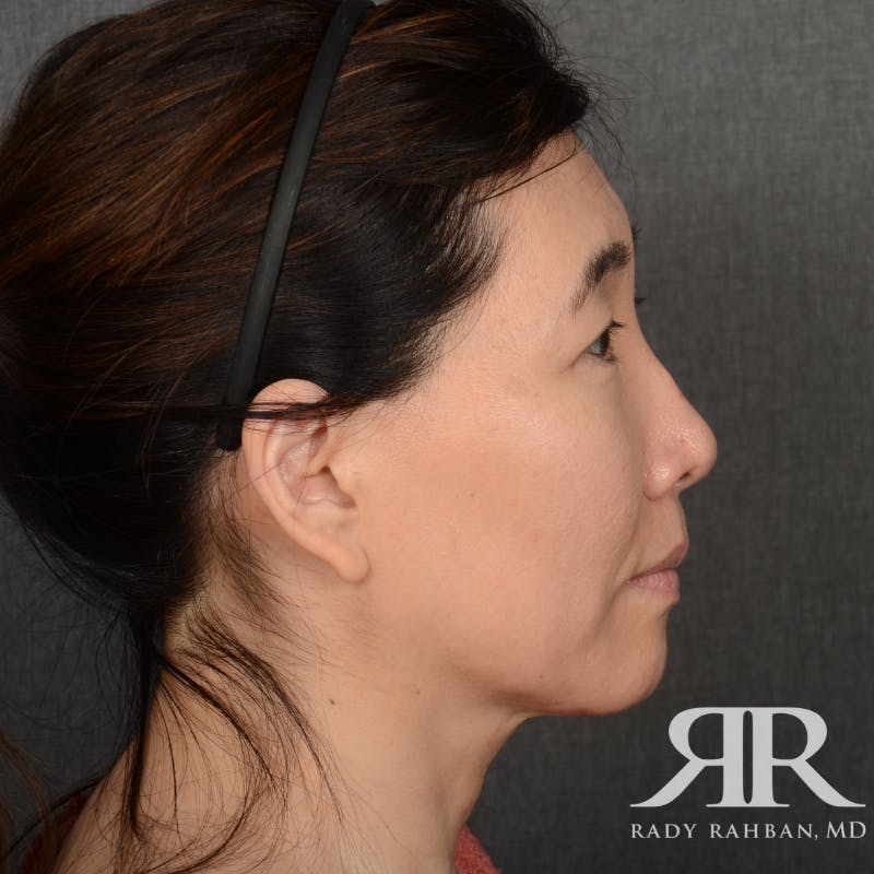 Facelift Before & After Gallery - Patient 201733 - Image 5
