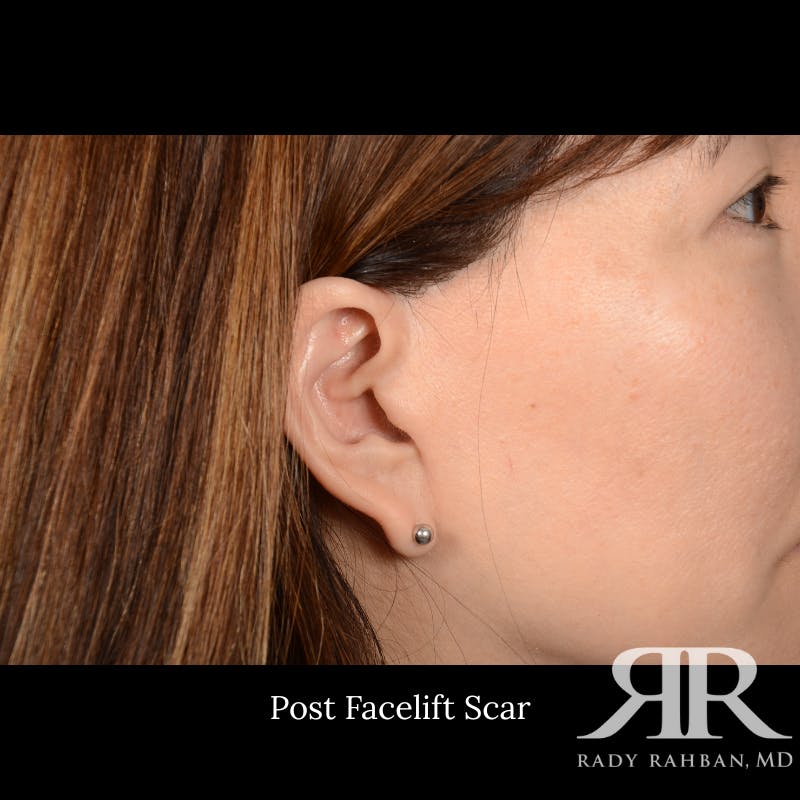 Facelift Before & After Gallery - Patient 201733 - Image 8