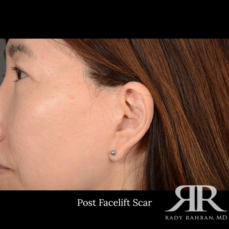 Facelift Before & After Gallery - Patient 201733 - Image 7