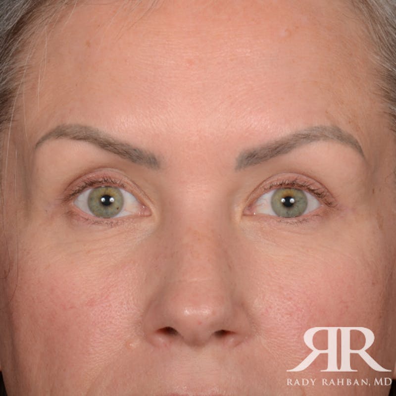Eyelid Surgery Before & After Gallery - Patient 157396 - Image 2