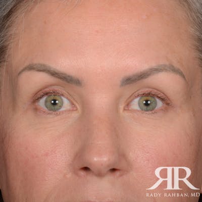 Eyelid Surgery Before & After Gallery - Patient 157396 - Image 2