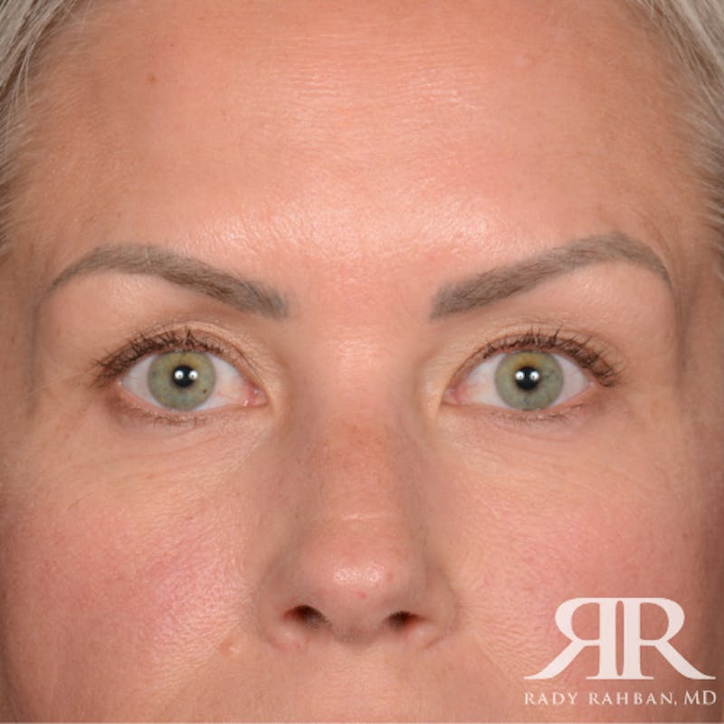 Eyelid Surgery Before & After Gallery - Patient 157396 - Image 1