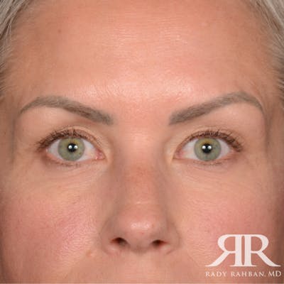Eyelid Surgery Before & After Gallery - Patient 157396 - Image 1
