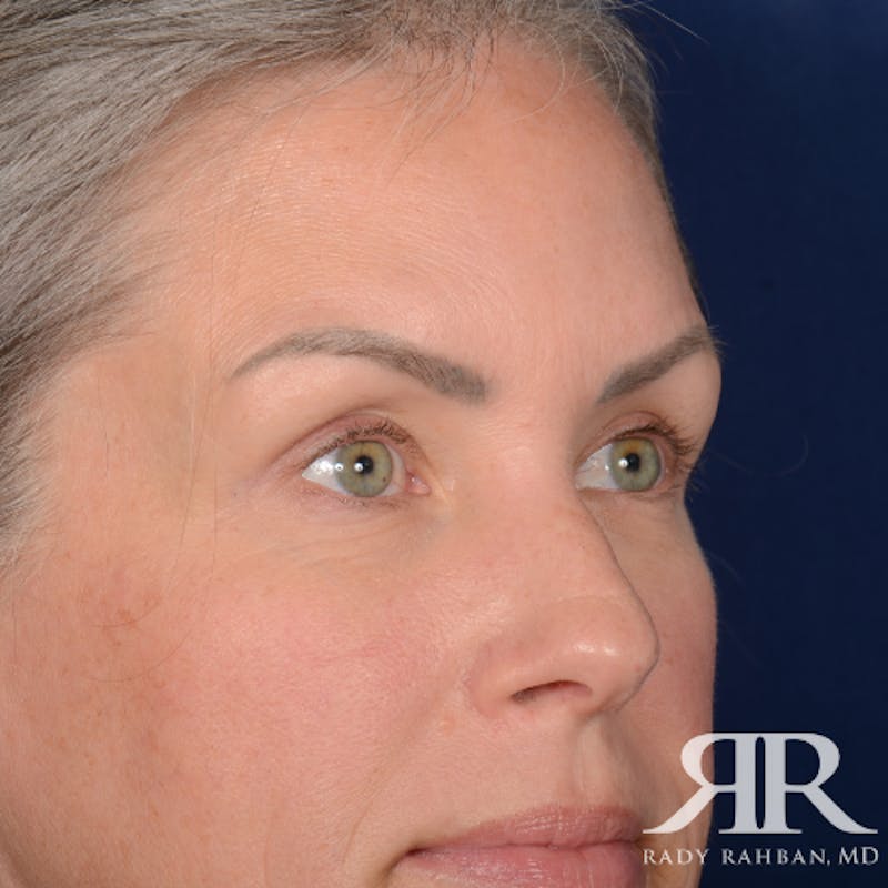 Eyelid Surgery Before & After Gallery - Patient 157396 - Image 4