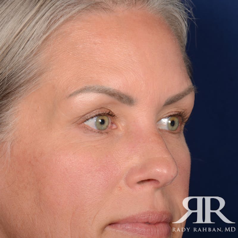 Eyelid Surgery Before & After Gallery - Patient 157396 - Image 3