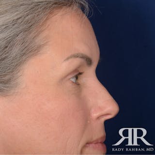 Eyelid Surgery Before & After Gallery - Patient 157396 - Image 6