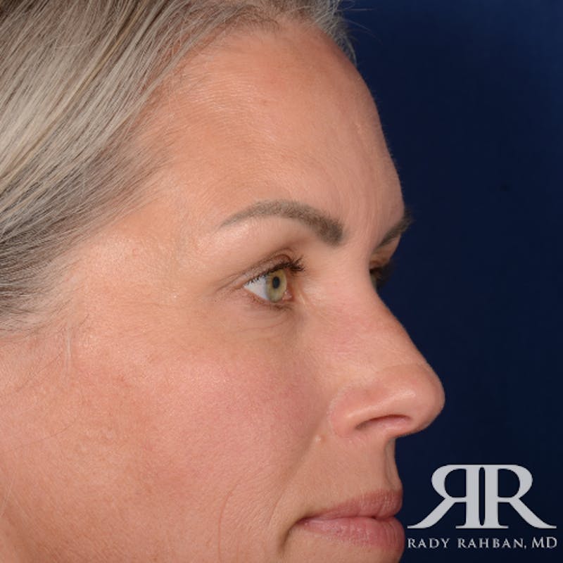 Eyelid Surgery Before & After Gallery - Patient 157396 - Image 5