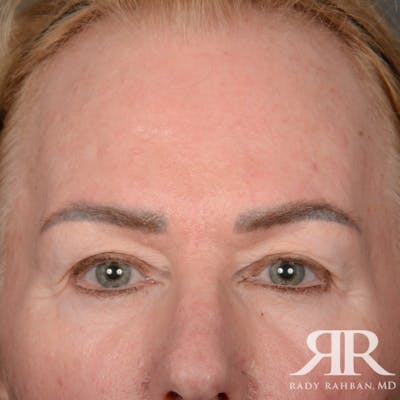 Eyelid Surgery Before & After Gallery - Patient 169302 - Image 1