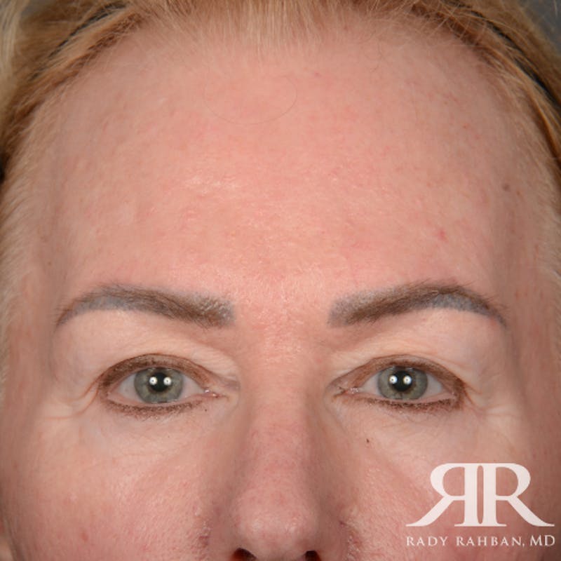 Eyelid Surgery Before & After Gallery - Patient 169302 - Image 1