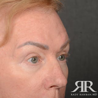 Eyelid Surgery Before & After Gallery - Patient 169302 - Image 4