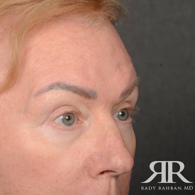 Eyelid Surgery Before & After Gallery - Patient 169302 - Image 4