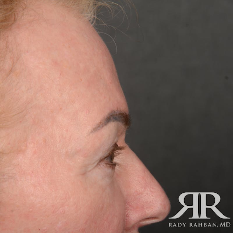 Eyelid Surgery Before & After Gallery - Patient 169302 - Image 5