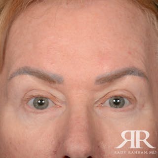 Eyelid Surgery Before & After Gallery - Patient 169302 - Image 2